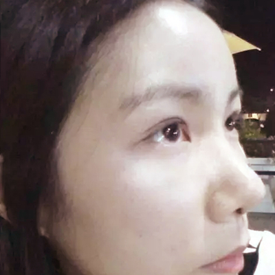 隆鼻整形+雙眼皮手術(shù)兩個月了，分享恢復前后對比果照片~