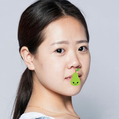 中加科洋做埋線雙眼皮一個(gè)月了，分享術(shù)后果照片~