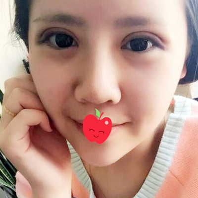 中加科洋做埋線雙眼皮一個(gè)月了，分享術(shù)后果照片~