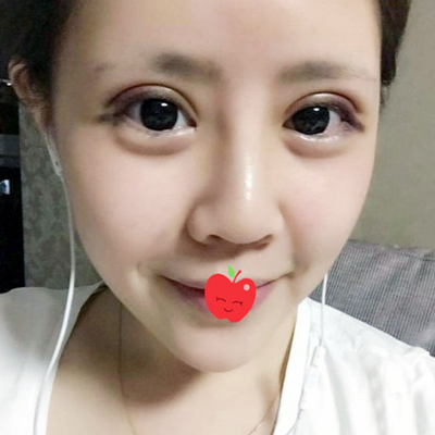 中加科洋做埋線雙眼皮一個(gè)月了，分享術(shù)后果照片~