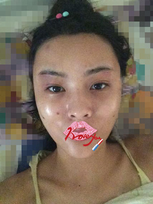 自體脂肪填充全臉，我也可以美美噠