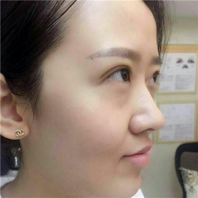 光子嫩膚快一個(gè)月了，分享手術(shù)過(guò)程和前后對(duì)比果圖片哦~