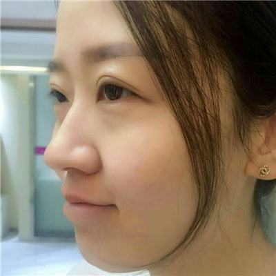 光子嫩膚快一個(gè)月了，分享手術(shù)過(guò)程和前后對(duì)比果圖片哦~