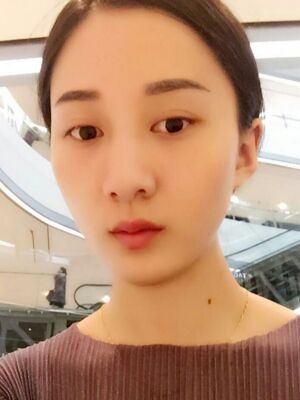 激光祛斑前后對比圖，雀斑全都沒啦