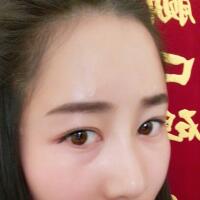 自體脂肪填充太陽穴豐額頭親身經(jīng)歷，多過程恢復(fù)圖分享