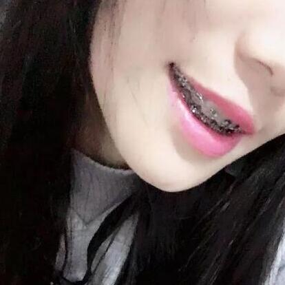 牙齒矯正的真實(shí)過(guò)程，現(xiàn)在我終于可以露出牙齒放聲大笑了
