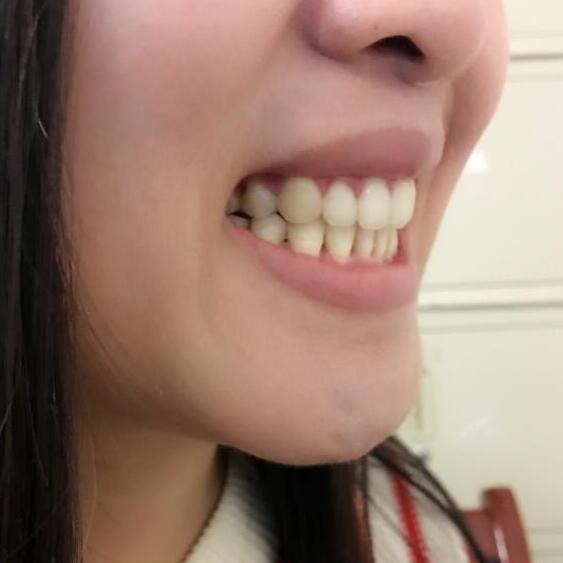 牙齒矯正前后對(duì)比照真實(shí)過(guò)程分享終于不是齙牙妹了哦