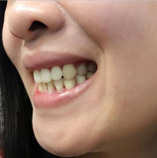牙齒矯正前后對(duì)比照真實(shí)過(guò)程分享終于不是齙牙妹了哦