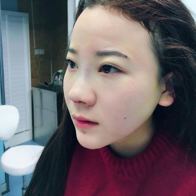 隆鼻整形前后恢復(fù)過程隆鼻梁+墊鼻尖整形果很好哦