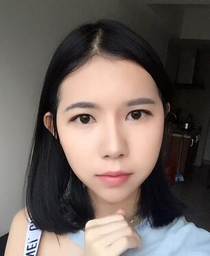 自體脂肪填充恢復(fù)日志 自體脂肪填充太陽(yáng)穴+額頭