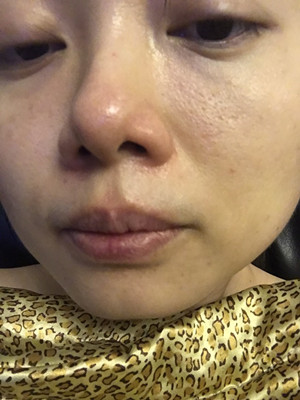 做了高強(qiáng)度聚焦超聲，果還不錯(cuò)，想把經(jīng)歷分享給大家
