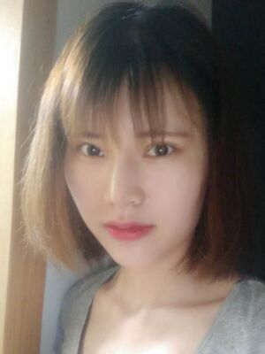 隆鼻整形真實恢復期圖片，大鼻子終于變秀氣了