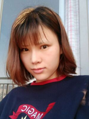 隆鼻整形真實恢復期圖片，大鼻子終于變秀氣了