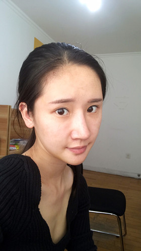 56000元做的自體脂肪填充蘋果肌+太陽穴，大家來看看果怎么樣