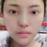 假體隆鼻15天后恢復(fù)圖，隆鼻果自然