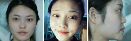 假體隆鼻15天后恢復圖，隆鼻果自然