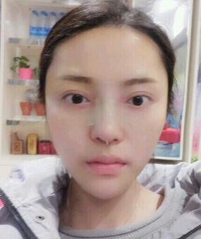 假體隆鼻15天后恢復圖，隆鼻果自然