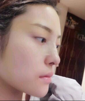 假體隆鼻15天后恢復圖，隆鼻果自然