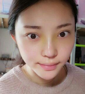 假體隆鼻15天后恢復圖，隆鼻果自然