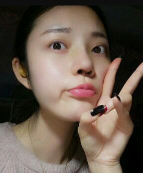 假體隆鼻15天后恢復圖，隆鼻果自然