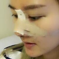 硅膠假體隆鼻過程和隆鼻前后圖片，真實(shí)案例分享