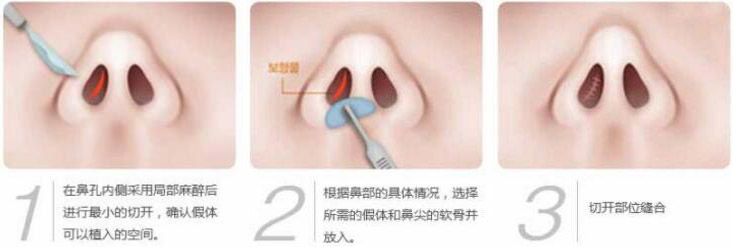硅膠假體隆鼻過程和隆鼻前后圖片，真實(shí)案例分享
