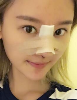 硅膠假體隆鼻過程和隆鼻前后圖片，真實(shí)案例分享