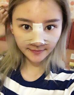 硅膠假體隆鼻過程和隆鼻前后圖片，真實(shí)案例分享