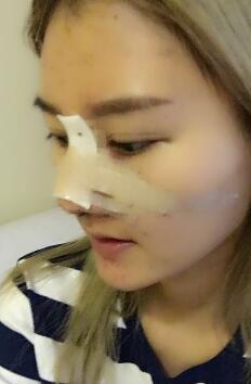 硅膠假體隆鼻過程和隆鼻前后圖片，真實(shí)案例分享