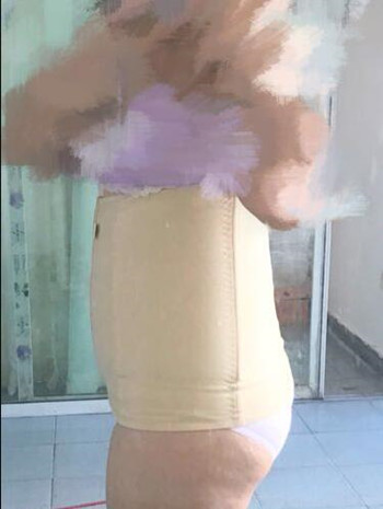 腰腹吸脂整形花了我兩萬(wàn)多的錢  果真的挺不錯(cuò)的