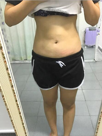 腰腹吸脂整形花了我兩萬(wàn)多的錢  果真的挺不錯(cuò)的