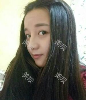 韓式隆鼻整形真實恢復期圖片，自然不夸張