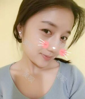 韓式隆鼻整形真實恢復期圖片，自然不夸張