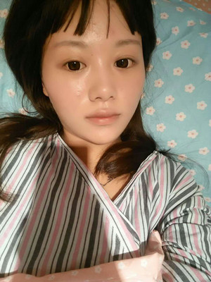 做完自體脂肪豐胸手術3個月啦!來看看前后對比照片哦