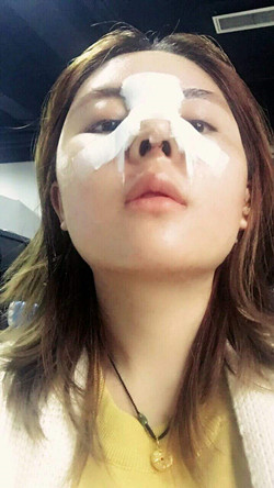 歪鼻矯正+假體隆鼻前后手術過程圖片分享