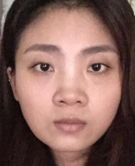鼻子整形過程恢復圖片，真實案例分享