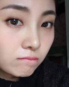 鼻子整形過程恢復圖片，真實案例分享