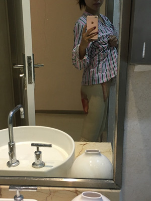 武漢同濟(jì)馮幼平水動力吸脂瘦大腿前后對比照片~真實案例圖分享