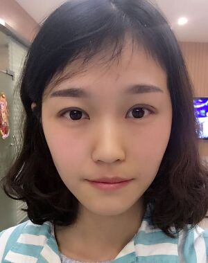 韓式微創(chuàng)雙眼皮恢復(fù)圖，超自然微創(chuàng)跡