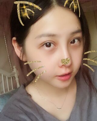 全切雙眼皮+開(kāi)眼角前后對(duì)比照片圖