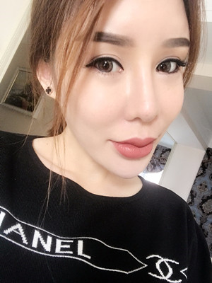 高強度聚焦超聲手術(shù)三個月的前后恢復(fù)記錄——?？诩t妝李科做的