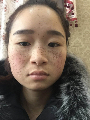 激光祛雀斑真實案例以及前后對比圖分享——?？诩t妝李杰做的