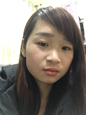 激光祛雀斑真實案例以及前后對比圖分享——?？诩t妝李杰做的