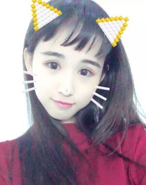 三點(diǎn)定位雙眼皮恢復(fù)實(shí)例，張永義做的