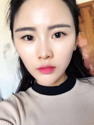 自體脂肪填充全臉經(jīng)歷，臉型超**的