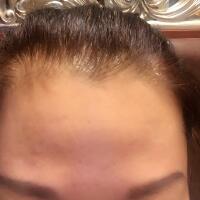 去抬頭紋很好的方法是注射注射瘦臉，恢復(fù)過(guò)程圖分享