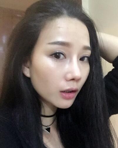 隆鼻整形真實(shí)恢經(jīng)歷 曬圖啦！