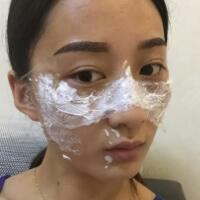 有誰做過激光祛雀斑？個人激光祛雀斑后恢復日記分享