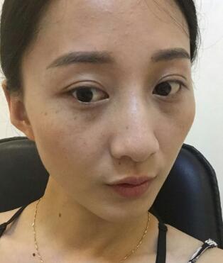 有誰做過激光祛雀斑？個人激光祛雀斑后恢復日記分享
