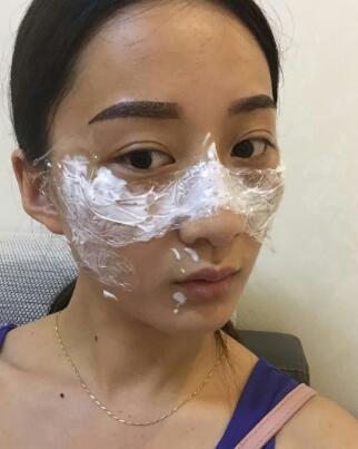 有誰做過激光祛雀斑？個人激光祛雀斑后恢復日記分享